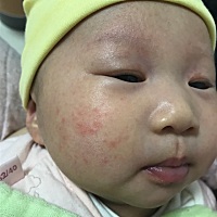 宝宝脸上长得这个是什么，有人知道吗？有什么办法可以弄好？求解.