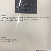 有一个月没检查了，今天一切正常，终于安心了，希望所有宝妈们都一切顺利。