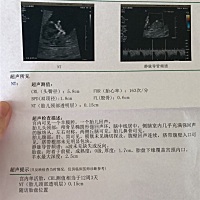 正常吗，测出来比实际大两天呢。脑壳偏大吗，还有羊水和胎盘，心率也高