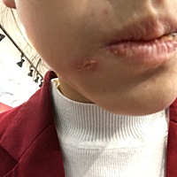 最近这几天上火太厉害了，怀孕54天，嘴这里好痒，有什么好的解决方法啊，