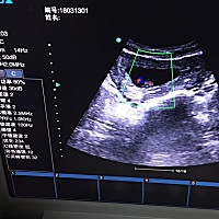 谁会看看这是女宝男宝 很好奇医生叫拍的