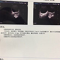 Hcg不翻倍，但是今天检查有胎心胎芽了，好开心，但是还是好担心怕长的不好