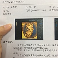 12周＋刚去医院照的NT 胎儿图片出现疑似是男孩的生殖器官，才12周 有可能看得出来吗？