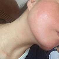 不知道是干嘛了这个脸、脱皮紧绷发痒发红的！怀孕期间就经常这样！生完小孩以后会恢复吗？有没有跟我一...