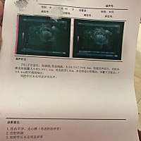 好好的，今天去照了B超，怎么就成这样了？从来没有肚子痛也没有出血见红，每天都有妊辰孕吐，饿了一定要...
