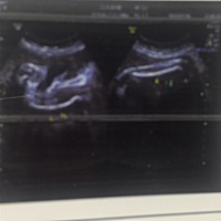 孕35 4   产检B超显示胎儿左侧股骨弯曲， 医生也没多给我多什么，就让我换个医院检查下， 之前产检都挺...