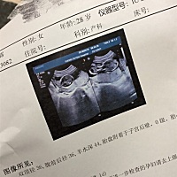 单子上看正常，就等一星期后的唐氏筛查的结果，有点怕。