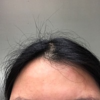 早上起来就这样了，满脸的痘痘，整张脸都是红的，孕13➕6，该怎么办啊？？？？？