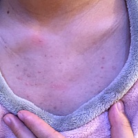 怀孕后到现在。胸前和后背都长这个，给医生看也没说什么……而且还满脸的痘痘……就是不知道生了孩子后...