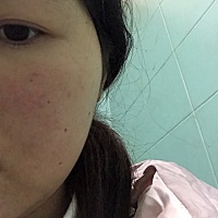 14周，今天的脸比昨天又严重了，满脸的红痘痘，自从怀孕后脸就没好过，三天两头长痘痘，昨天吃了芒果，...