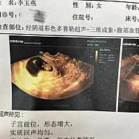 怀孕十周了，开心，昨天检查没问题！