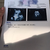 有没有人会看孕囊b超滴？大家帮我看看男宝还是女宝宝啊？谢谢🙏