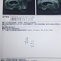 怀孕57天，医生说孕囊大胚胎小，有流产的可能，建议我住院