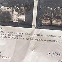 第一次彩超，能看出男女吗？哈哈