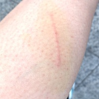 刚被朋友家的狗狗抓到了 有一条红痕 狗狗5个月左右 2.3个月的时间接种了狗狗的狂犬疫苗 那我还一定要打...