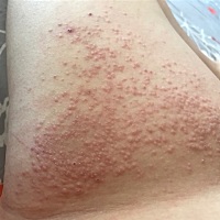 开春起的疹子可咋办啊……