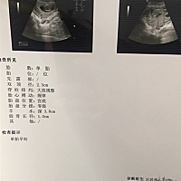 宝妈们 胎盘宫底 一般是子宫前位还是后位 有知道的吗？谢谢啦