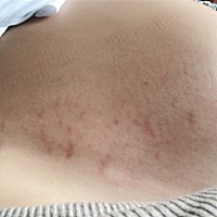 我的肚子大腿都花了。你们的呢。抹了东西预防了感觉也没有用。