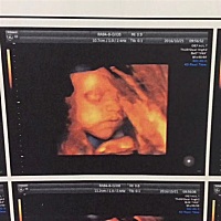 刚拍的四维 帮忙看看像男孩还是女孩？