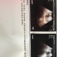 有没有跟我一样上个月六号的月经，现在已经六周了还没看见胎芽和心管搏动的，前几天有流褐色的东西，流...