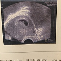 宝妈，都帮我看看我这个孕囊像什么形状！😄