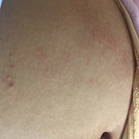 有同样症状的孕妈吗，你们怎么处理的，痒的晚上睡不着，只敢摸摸，不敢挠