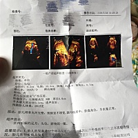 38周不到去妇幼保健院打的b超宝宝的双顶径9.3 腹围33 股骨长7.1 体重3000克 今天宝宝39 2我去我们这边人...