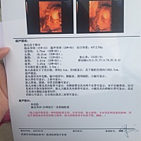 四维彩超能看出男女么