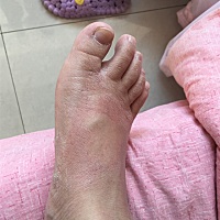 宝妈们，孕32周了，脚上不知道起了什么，又干又痒
