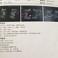 请专业人士解释下……1：B超单显示宝宝两侧有囊肿，有两种可能，第一种，宝宝真的有问题，第二种，宝宝...