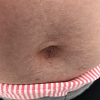 怀孕10W 4天 肚脐周围开始有花纹还有毛 肚子皮肤暗沉很难看 有和我一样的吗