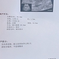 .NT筛查 能知道男女吗