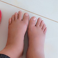 脚手肿的厉害，正常吗？37 3，有点担心是不是不正常？要不要去医院看看？有知道的姐妹吗！江湖救急？？...