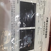 亲们，昨天去做的b超，结果如下，15天前我在医院是同一个大夫给做的b超，说刚着床，昨天的了，结果是有...