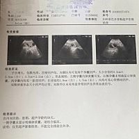 双胞胎 8周 5有谁看的懂b超单怀是男孩还是女孩
