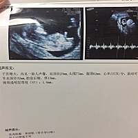 刚刚做好NT大家有谁能帮忙看看是男孩女孩？谢谢了，好奇到底男孩？女孩？