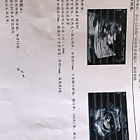 做了NT 不知道这样这种数据好不好 验血报告还没有出