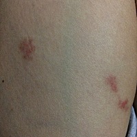 怀孕六个多月了，最近身上老是很痒忍不住用手抓，起了一块一块的红包，请问可以用红花油或者清凉油擦吗...