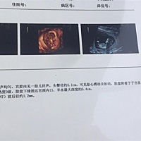 这是我12周刚做的nt.朋友们帮我看看是男宝还是女宝