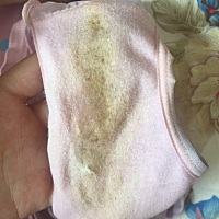 怀孕3个月。分泌物有黑色绒毛。什么情况