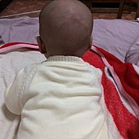 各位宝妈们，你们遇到过这样的脑袋有个圆印吗？要紧吗？