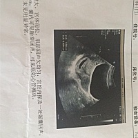 有经验的宝妈看看，第一张是50来天的，第二张是照的NT，会是个女宝宝吗？