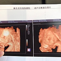 明天就39周了，没有任何反应，有没有和我一样没有发动的？