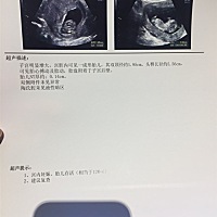 好奇，帮忙看看是男孩还是女孩？NT顺利通过～