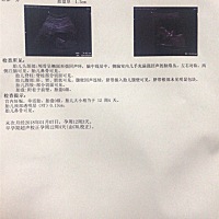 今天做NT 但是医生让我一个月后回来复查 怀疑单脐动脉是什么意思~~~有人懂吗