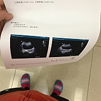 末次2月20号，中回声？这个b超正常吗