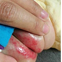 新生儿经验分享一：宝宝红屁股怎么办？而且都破了，宝宝很痛，怎么办啊？ 回答：1,注意宝宝的卫生.如果...