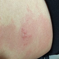 孕三月，肚子上长了一小块湿疹，有点痒是怎么回事啊，不知道能不能抹药