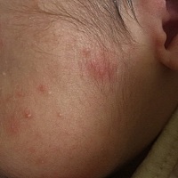 爸妈们孩子脸上起的这个是啥？