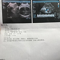 昨天拍的B超，现在36周了，医生说羊水偏少，这是第二胎因为一胎是剖腹产的也没有到预产期，现在这个也想...